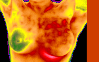 Termografia infravermelha digital – exame 100% seguro, sem dor e não invasivo